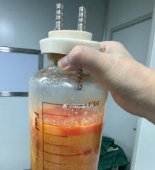 平邑水动力吸脂手术要做多久？